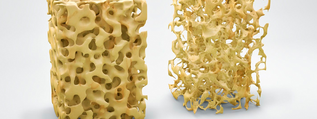 Modelo de osteoporosis